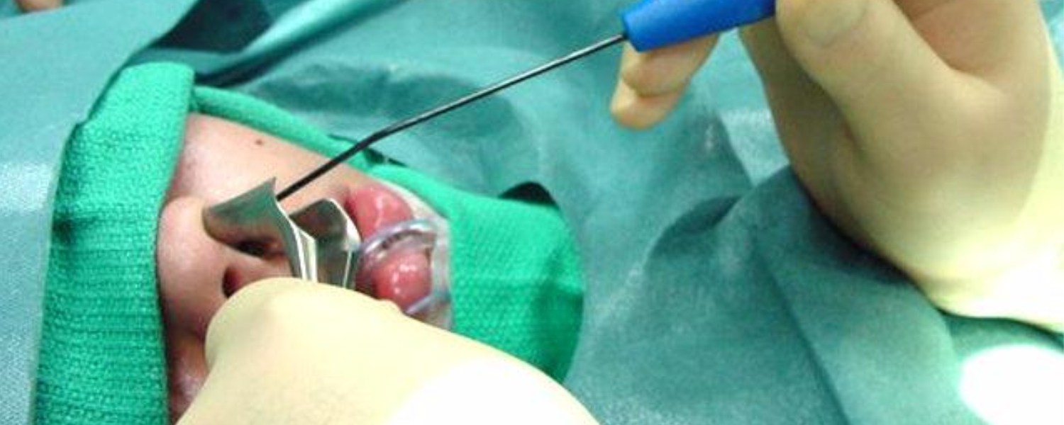 Best Hospital for Coblation Surgery in Nanded